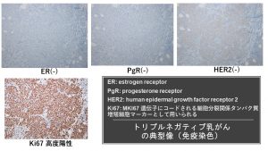 トリプルネガティブ乳がんの免疫染色パターン